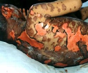 синдром лайелла лечение