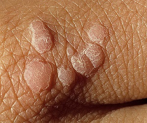 как удалить бородавку на ноге