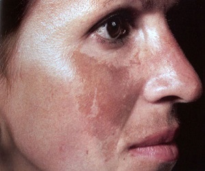 хлоазма фото