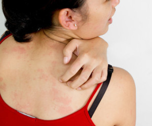 крапивница у взрослых фото