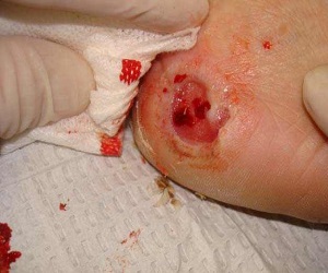 трофическая язва нижних конечностей лечение