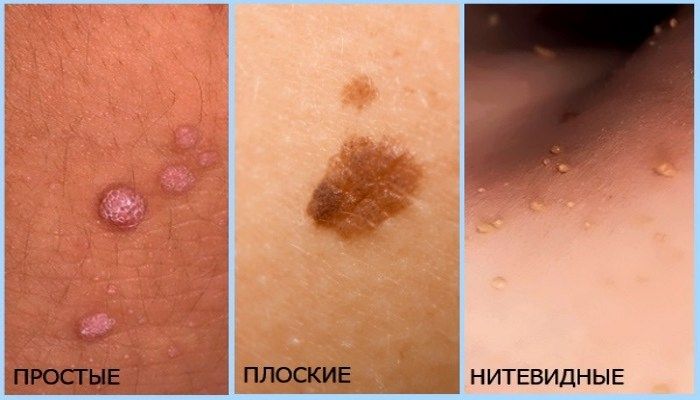 Виды заболевания