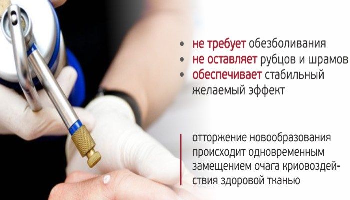 Криодеструкция