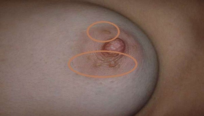 Папилломы на соске