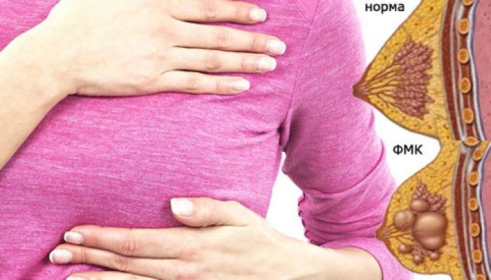 Заболевания молочных желез