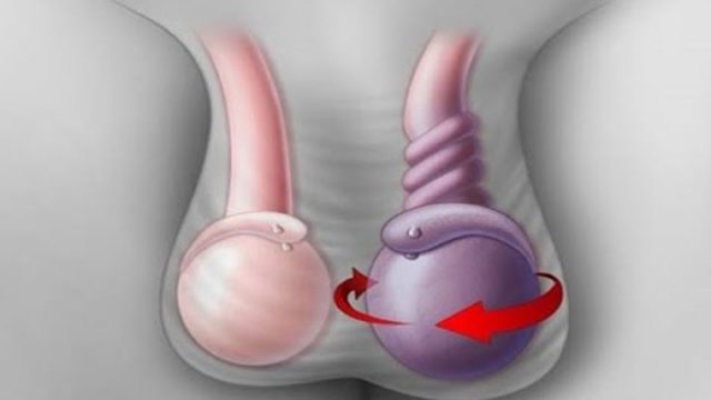 Перекрут яичка