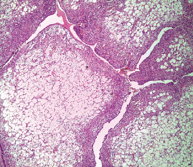 Листовидная фиброаденома Листовидная фиброаденома