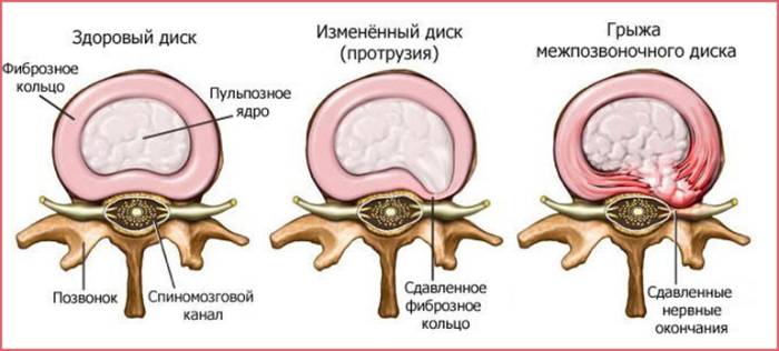 Протрузии и грыжи межпозвонковых дисков