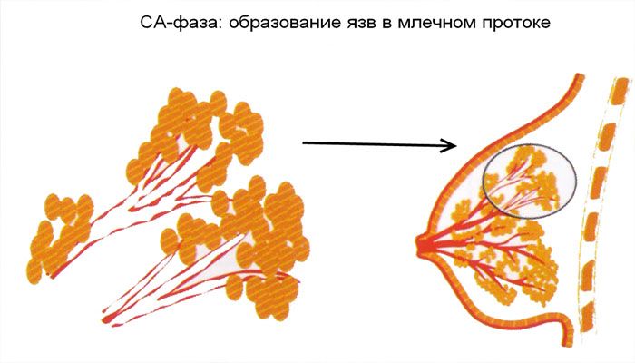 Образование язв в млечном протоке