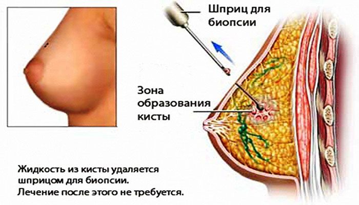Удаление жидкости из кисты