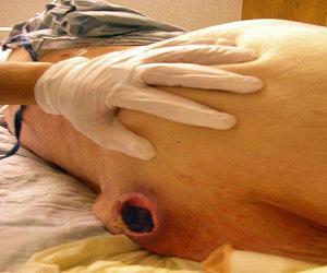 пролежни фото