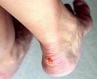 как избавиться от мозолей на пятках