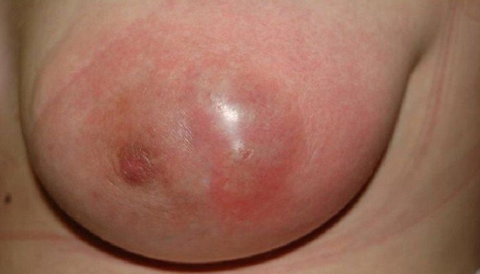 Серозный мастит