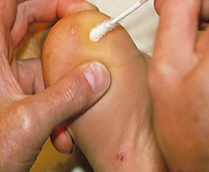 бородавки у ребенка