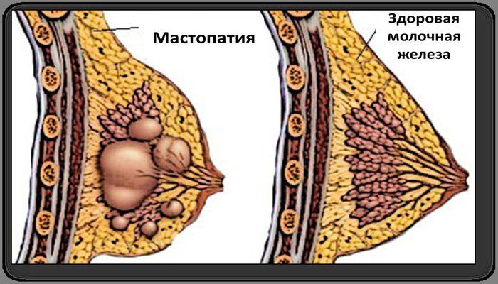 Мастопатия