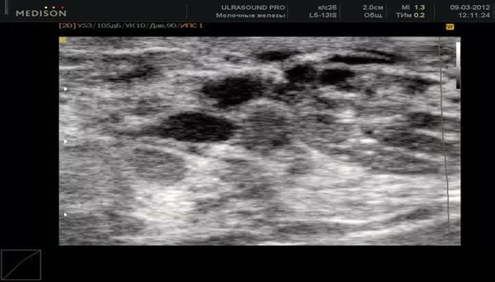 Железисто-фиброзная мастопатия