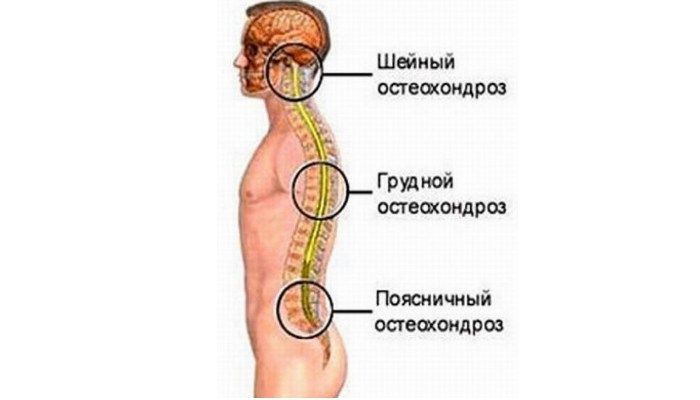 Остеохондроз
