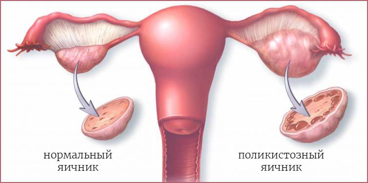 Поликистоз яичников