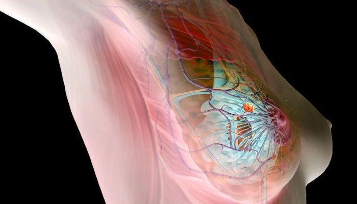 Инфильтрирующий рак