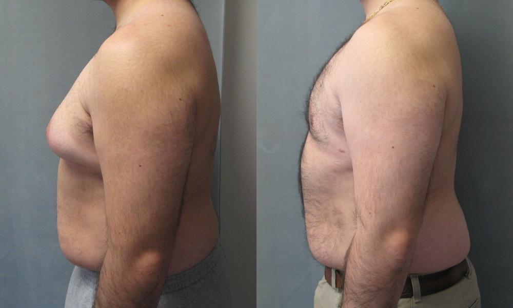 Гинекомастия