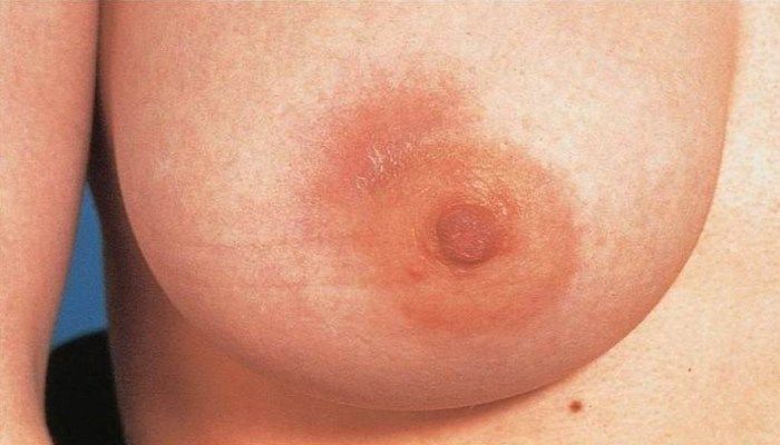 Боль в сосках