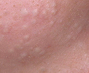 закрытые комедоны фото