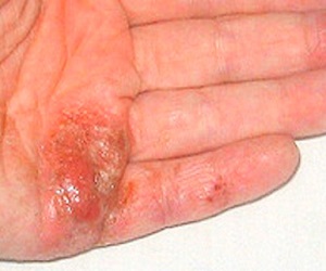 мокнущая экзема на руках