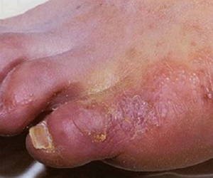 дерматомикоз гладкой кожи фото