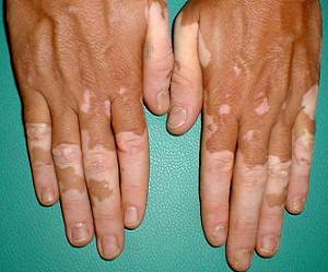 как лечить витилиго фото