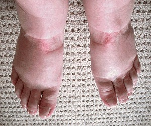 отек ноги в щиколотке