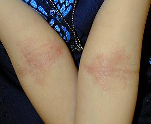 нейродермит фото