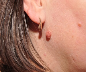 папилломатозный мелоноцинтарный невус