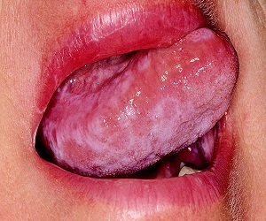 красный плоский лишай фото у человека