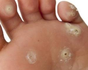 как убрать шипицу на ступне