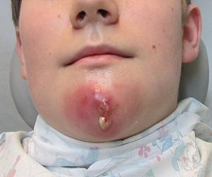 фурункулез лечение фото