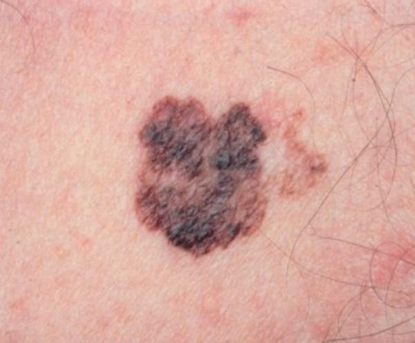 диспластический невус кожи