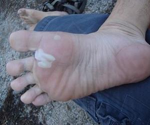 стержневая мозоль у детей фото