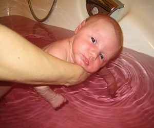 пиодермия у детей лечение фото