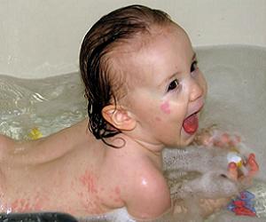 розеола у детей лечение фото