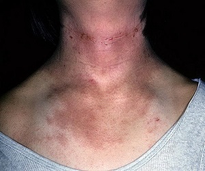 атопический дерматит фото