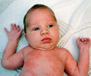 потница у новорожденных лечение фото