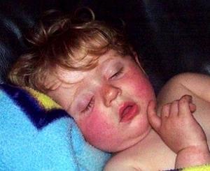 контактный дерматит у детей фото