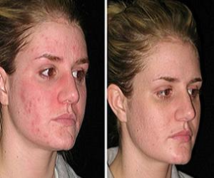 дифферин отзывы фото до и после