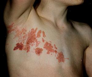 герпес опоясывающий фотографии