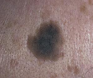 кератоз кожи лица фото