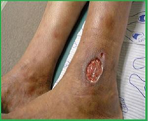 трофическая язва на ноге фото