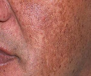 мелазма фото на лице