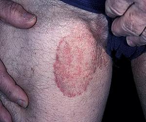паховая эпидермофития фото