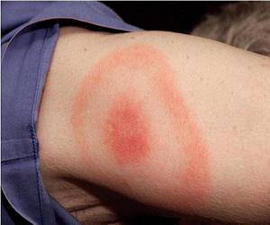 кольцевидная эритема у детей фото