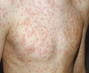 как выглядит краснуха фото у взрослых